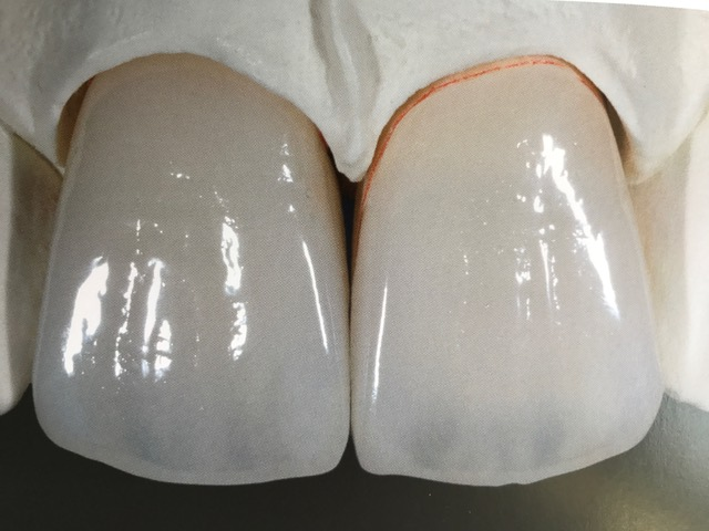 Verblendschalen (Veneers)